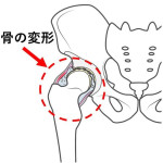 股関節骨の変形