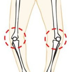 変形性の膝