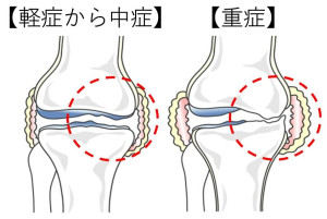 膝の骨の変形