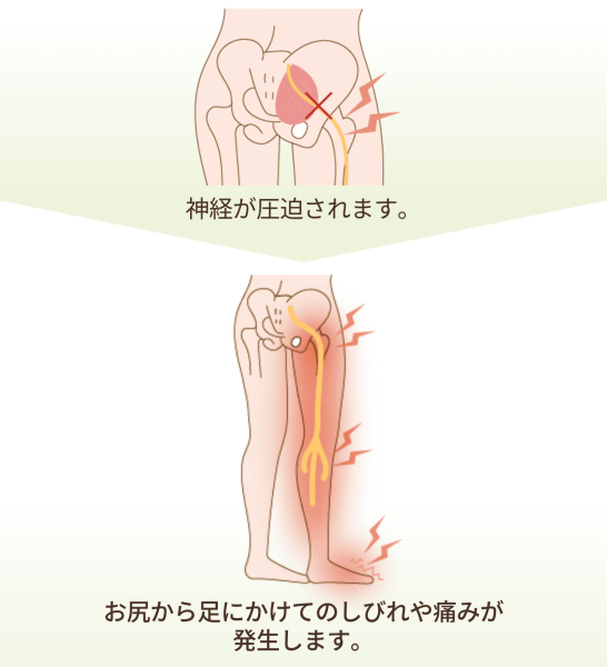 坐骨