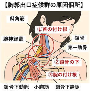 胸郭出口イラスト_page-0001